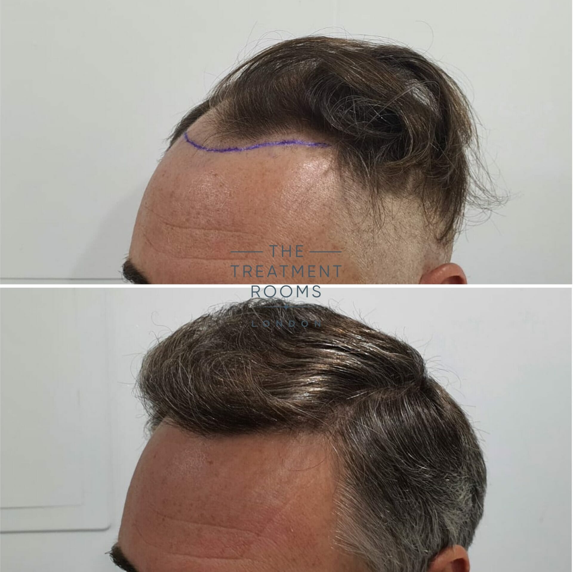 1824 grafts hair transplant before and after
