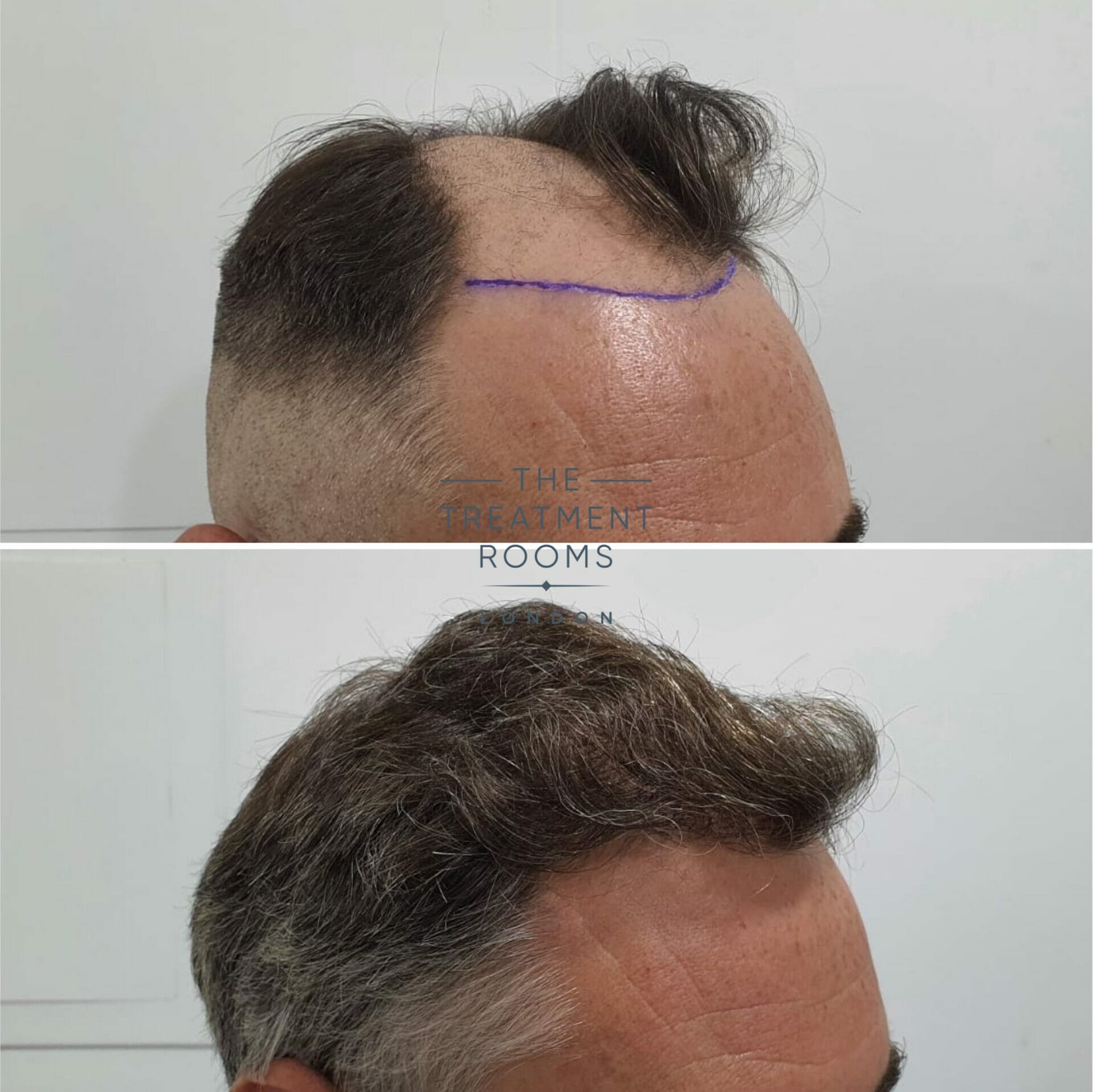 1824 grafts hair transplant hairline before and after