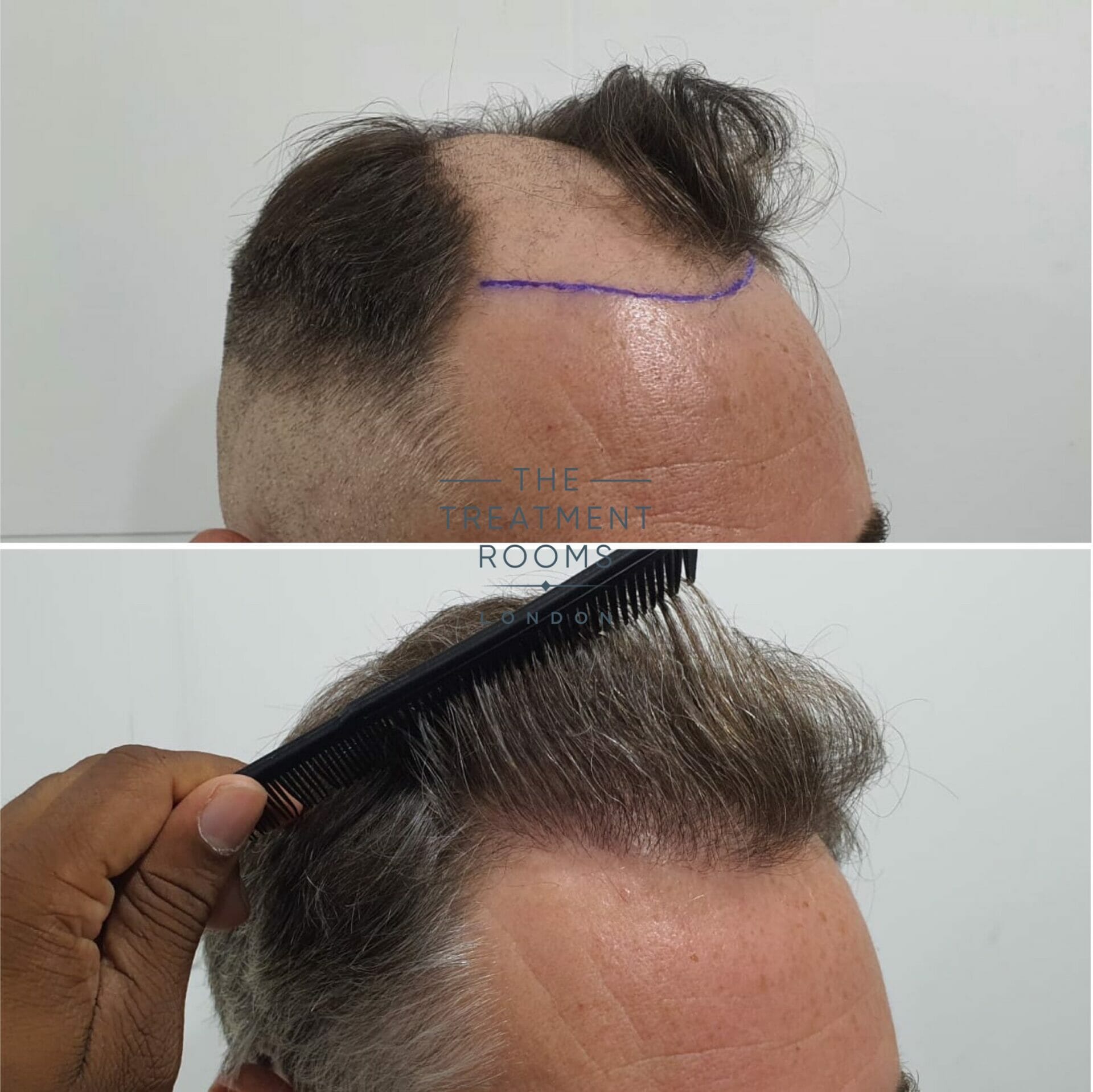 1824 grafts hair transplant result