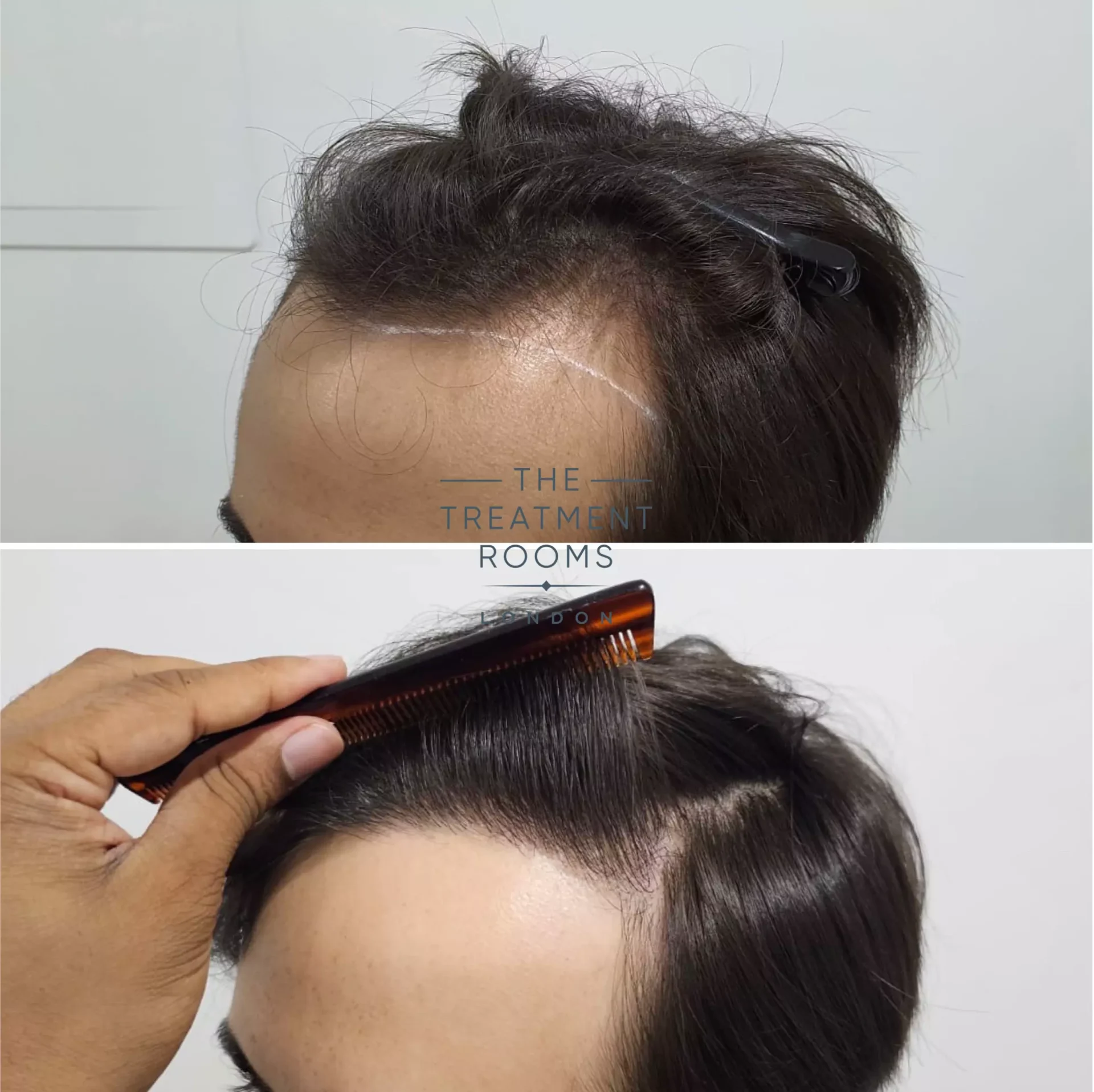 1856 grafts FUE hair transplant result