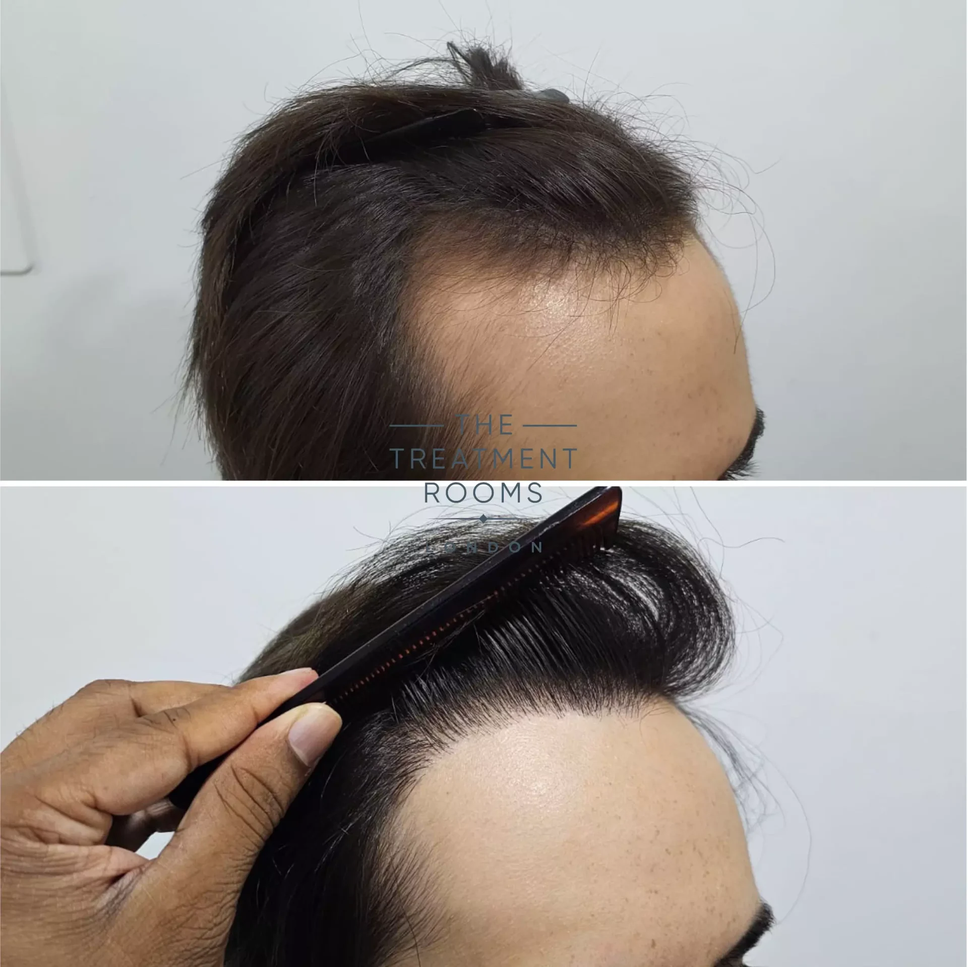 1856 grafts hairline FUE hair transplant