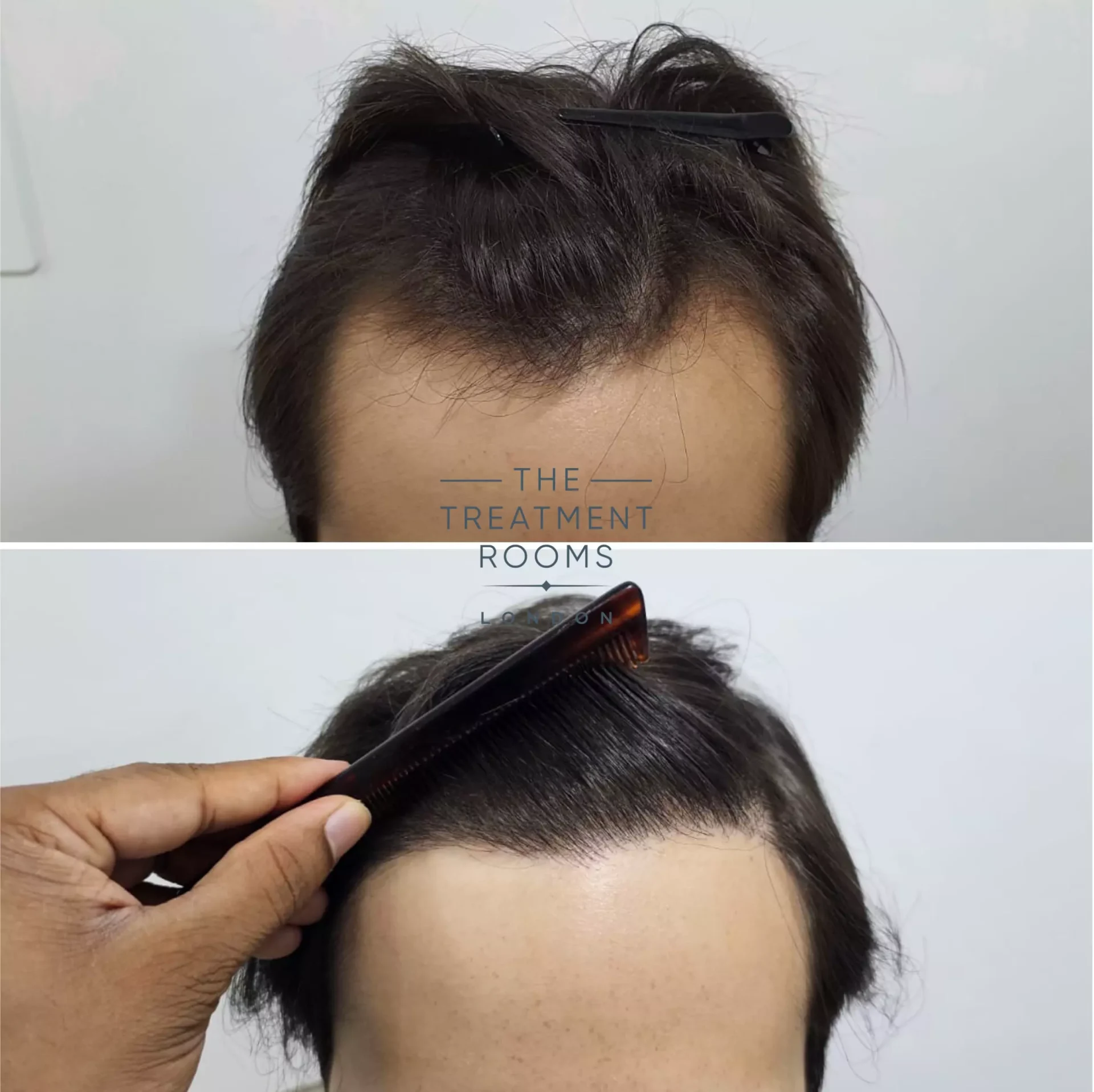 1856 grafts hairline FUE hair transplant before and after