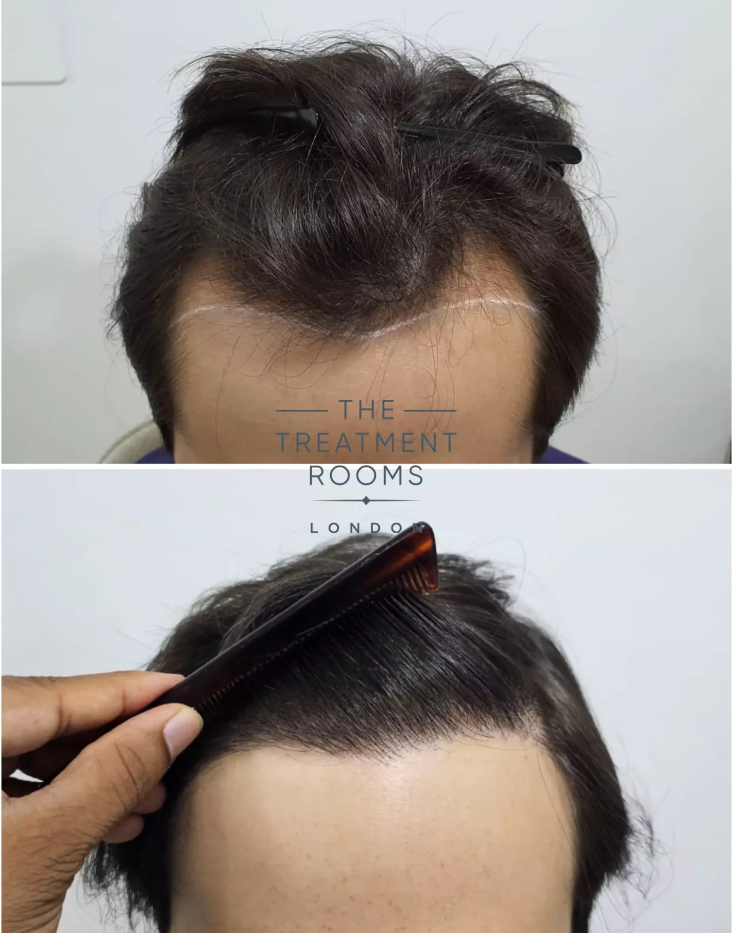 1856 grafts hairline FUE hair transplant chinese hair type