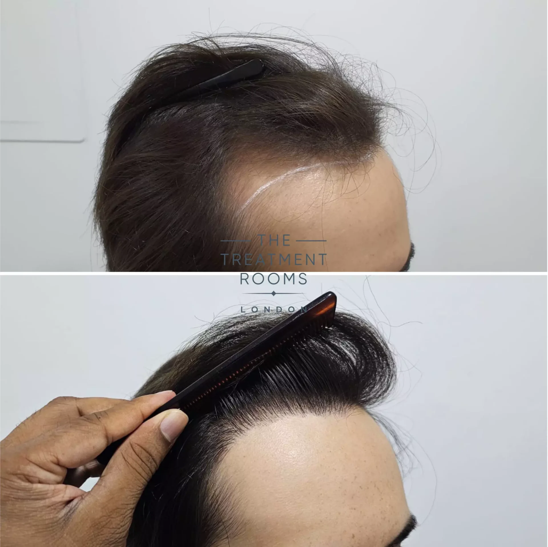 1856 grafts hairline hair transplant chinese hair type