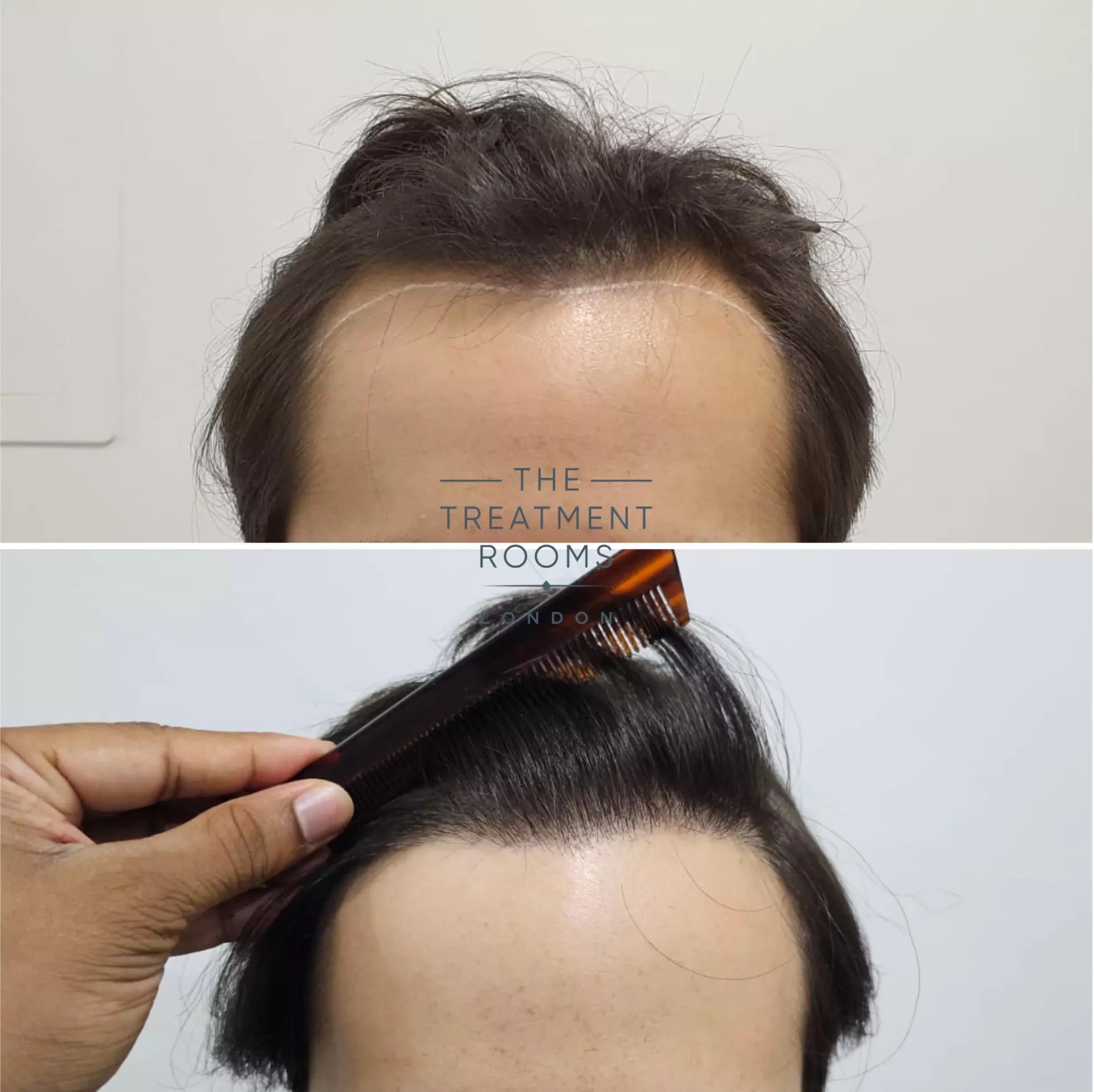 1856 grafts hairline hair transplant london before and after
