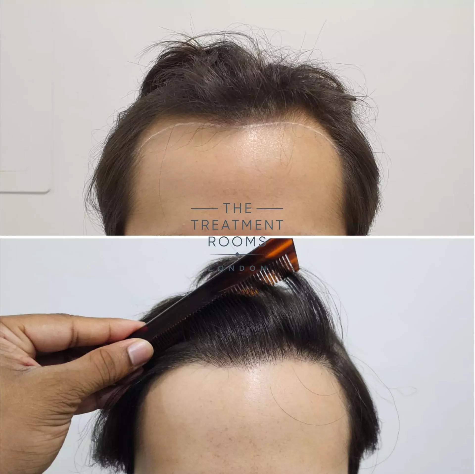 1856 grafts hairline hair transplant london before and after 1856 grafts hairline hair transplant london before and after
