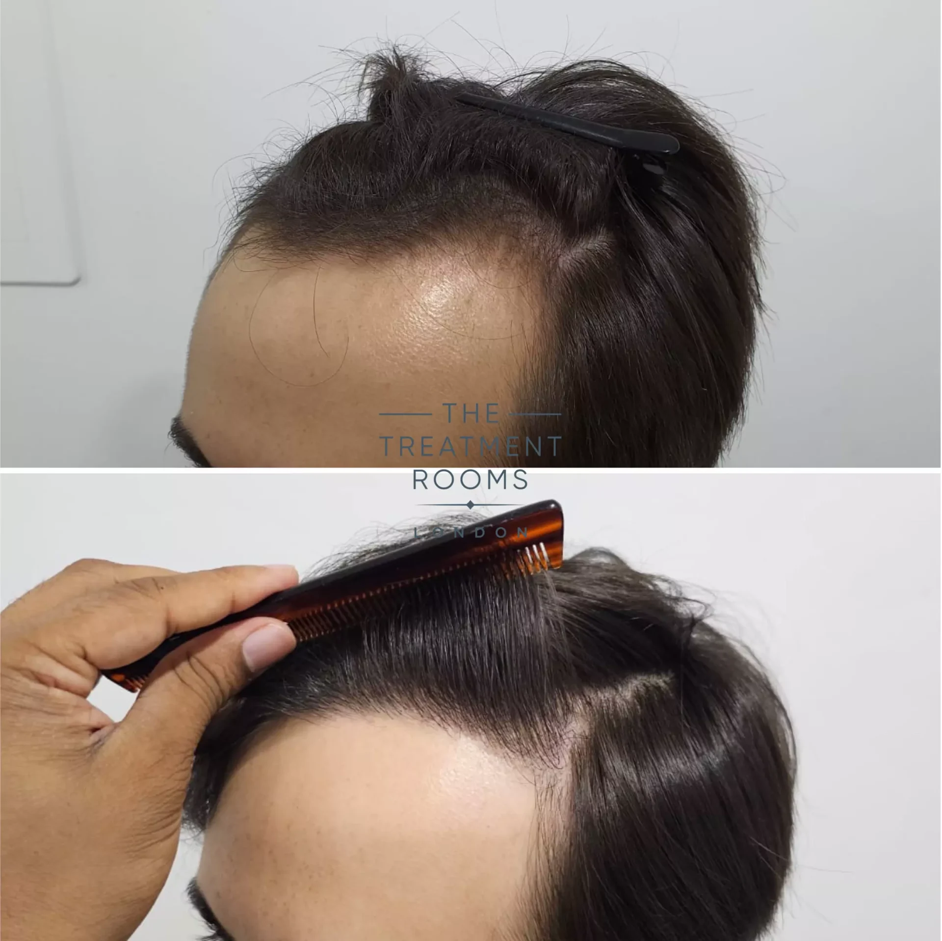 1856 grafts hairline hair transplant