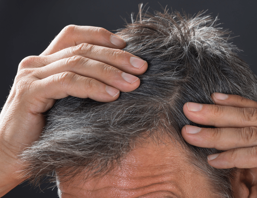 best age for a hair transplant