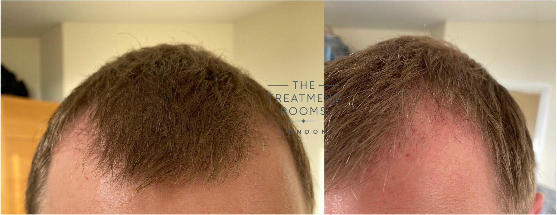 hair transplant timeline reddit