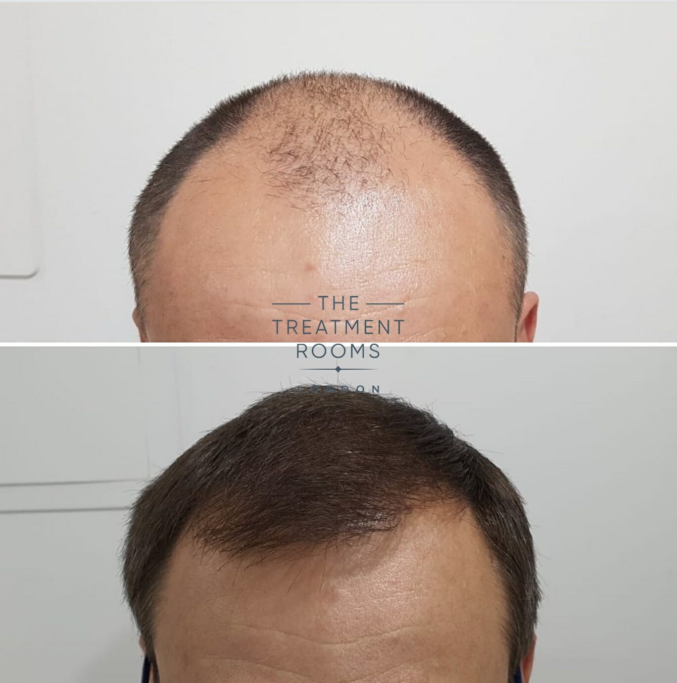 2000 graft FUE hair transplant hairline before and after