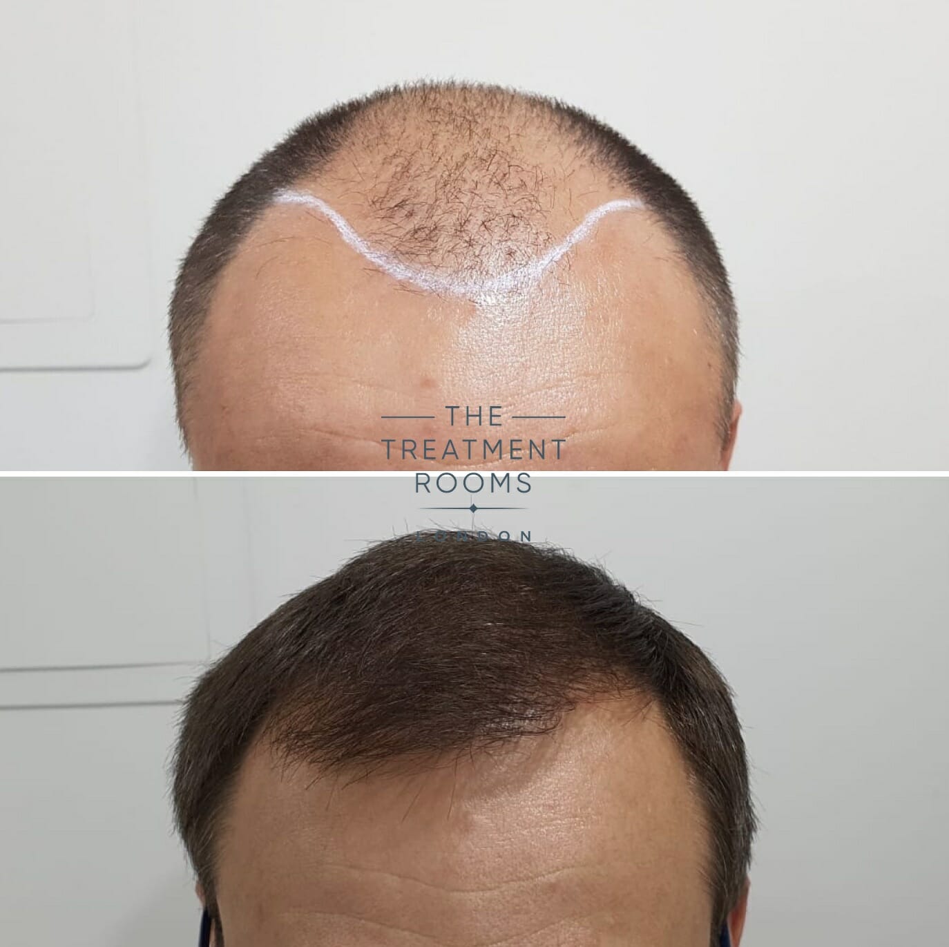 2000 graft FUE hair transplant result