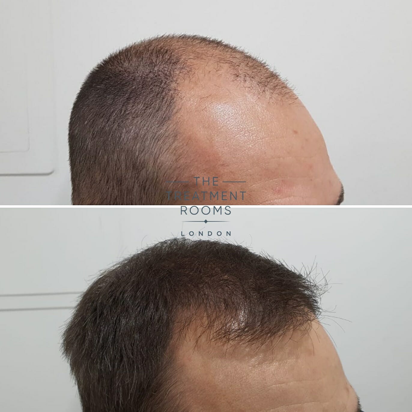 2000 graft hair transplant before and after