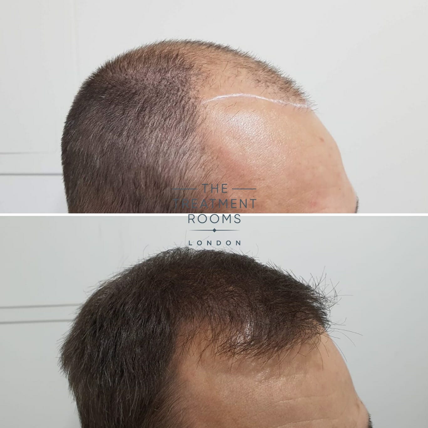 2000 graft hair transplant result