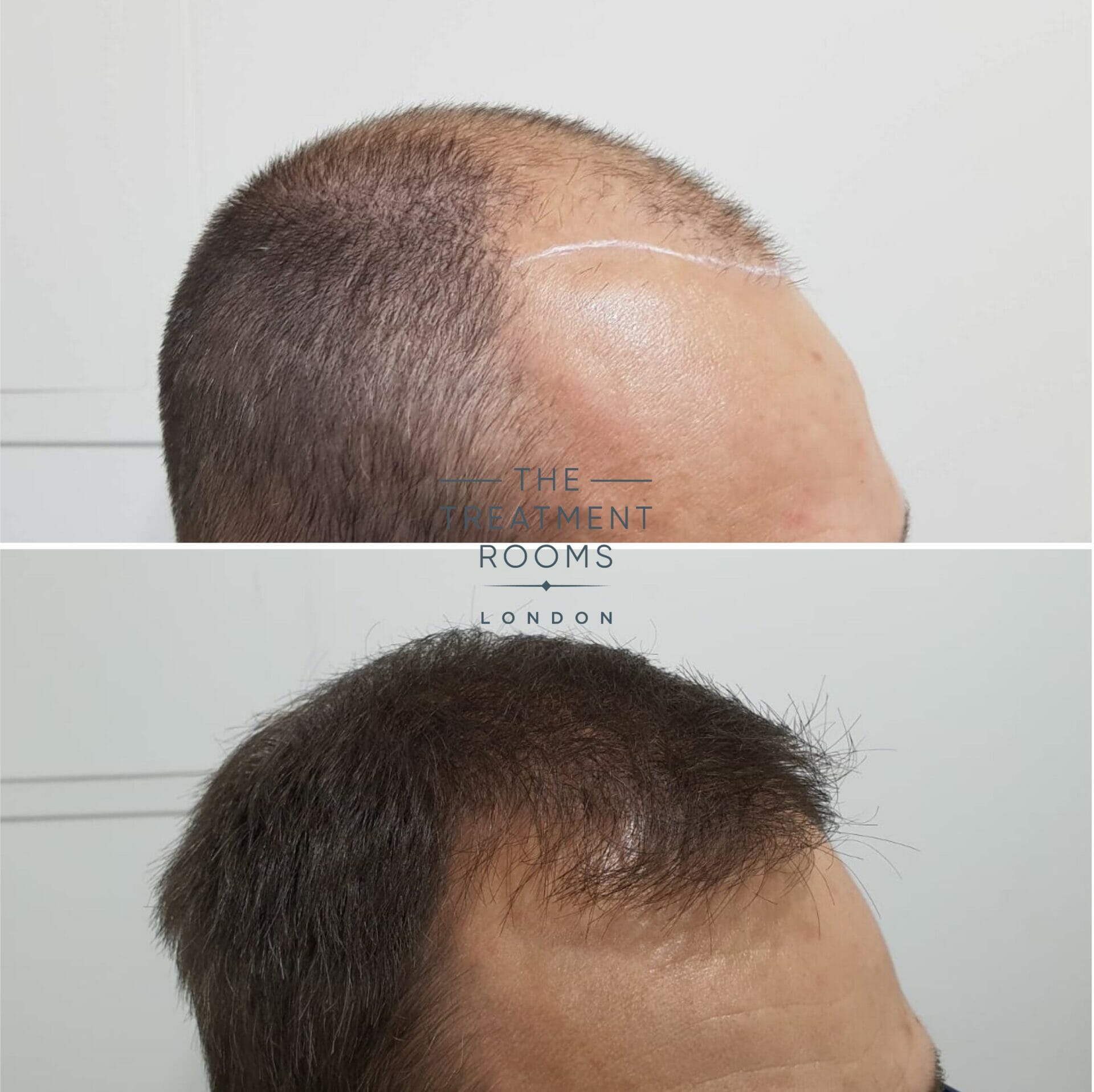 2000 grafts hair transplant