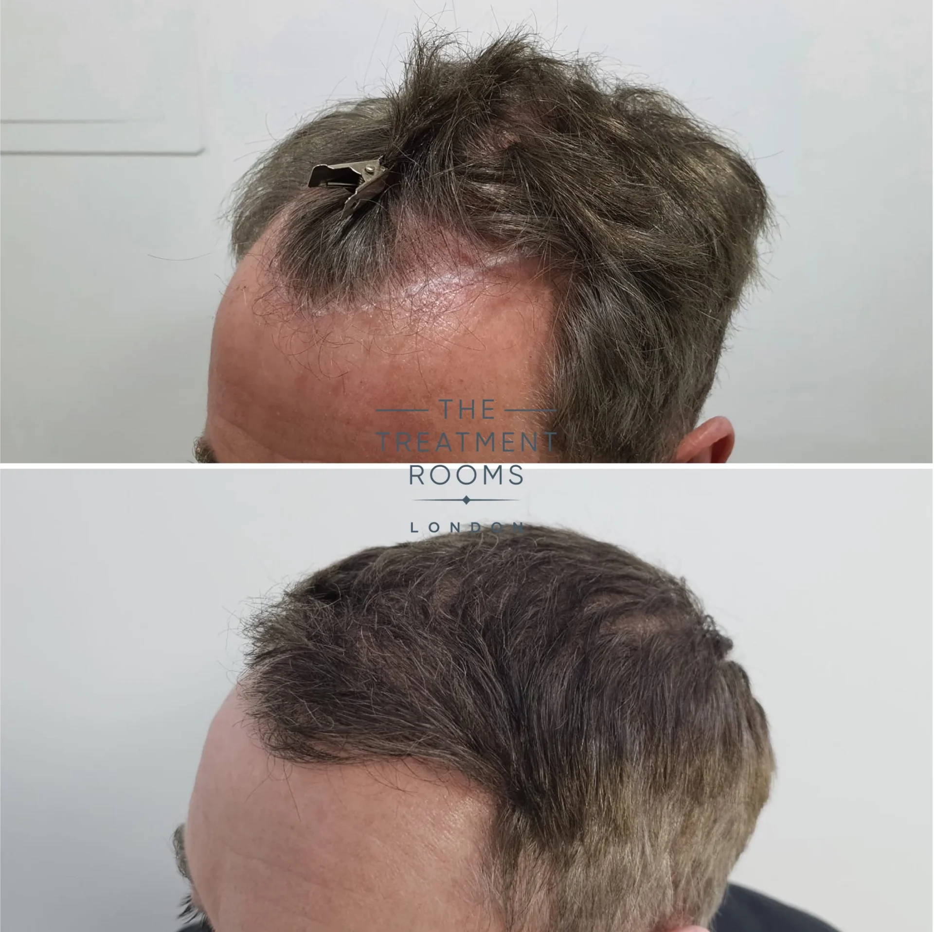2008 grafts fue hair transplant before and after
