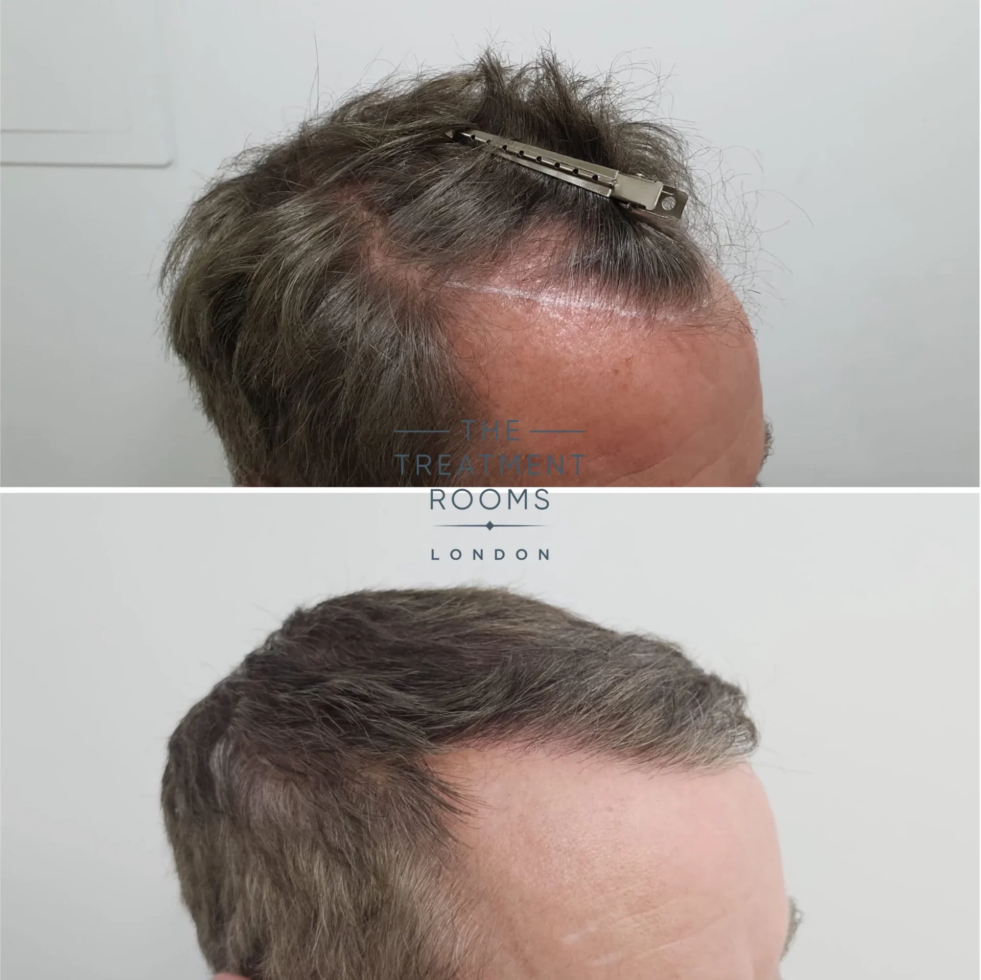 2008 grafts hair transplant before and after