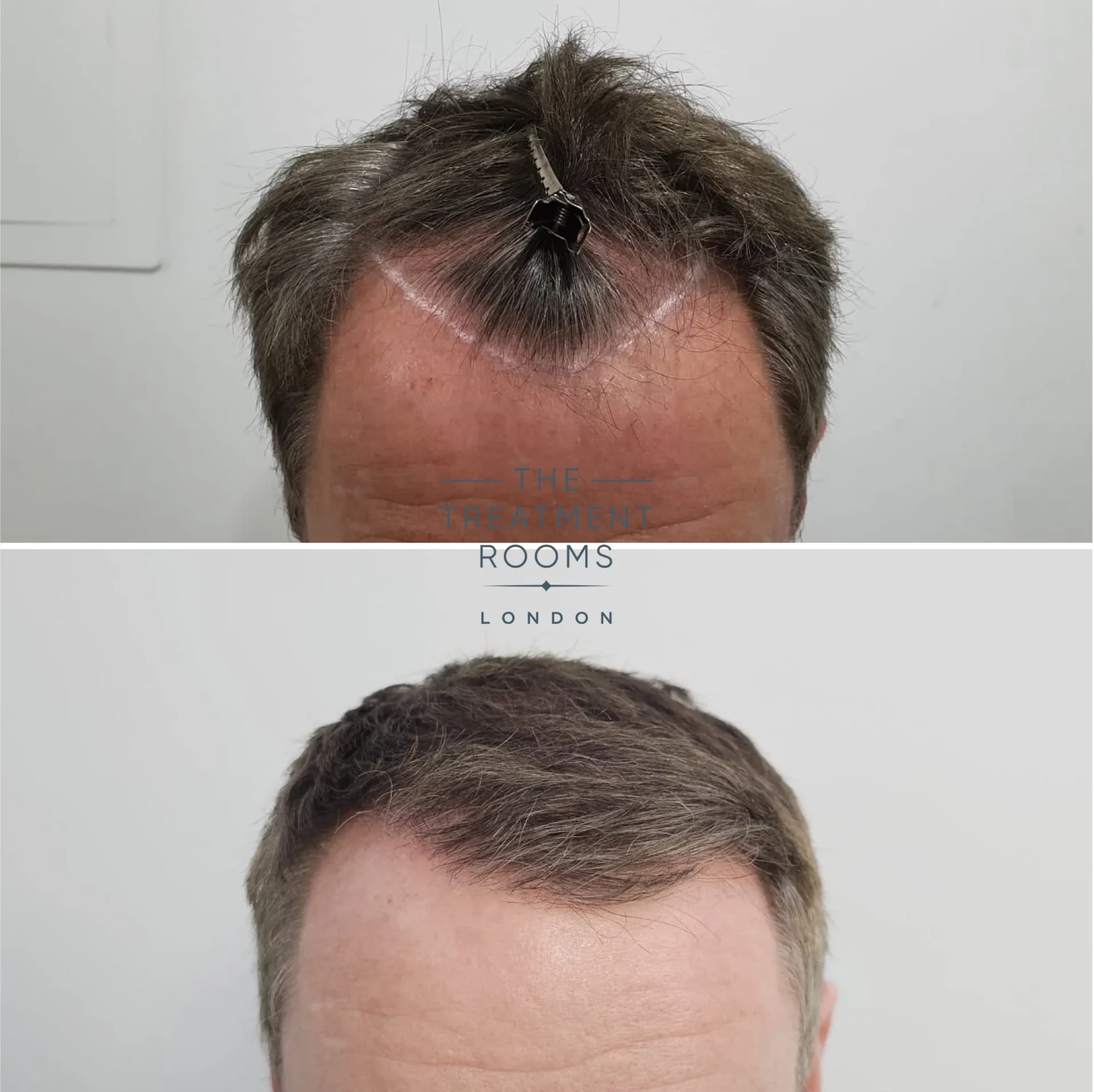 2008 grafts hair transplant result