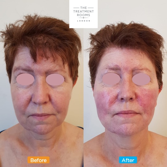 full face thread lift