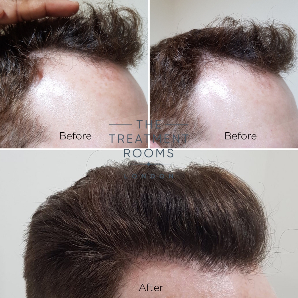 Temporal Hair Transplant