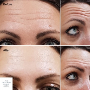 Botox near me
