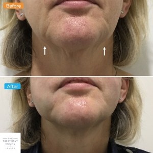 before and after chin and jowl pdo thread lift