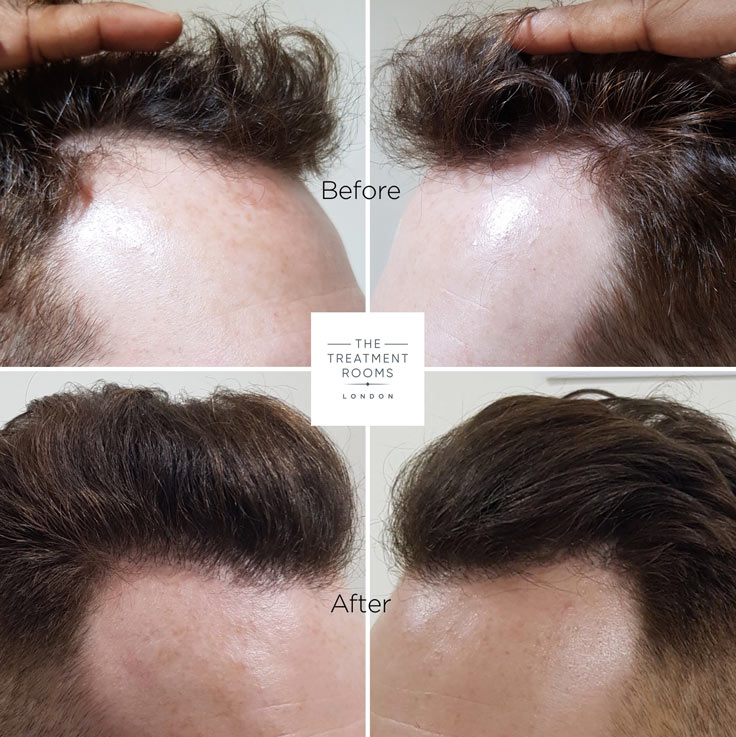 before and after hair transplant at the treatment rooms london