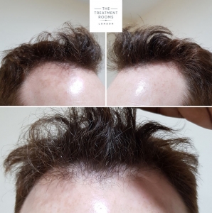 london hair loss clinic