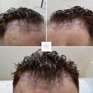 wandsworth hair transplant