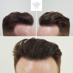 London Hair Transplant