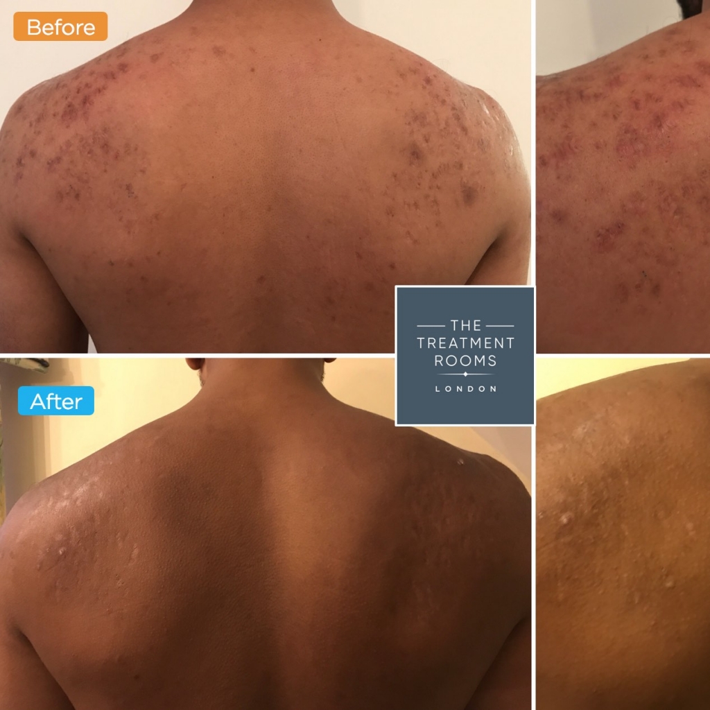 acne scar treatment