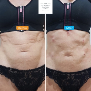 stomach thread lift
