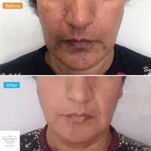 uneven skin treatment