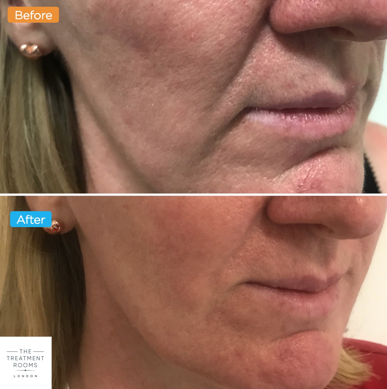 Vampire Facial Before And After All You Need Infos