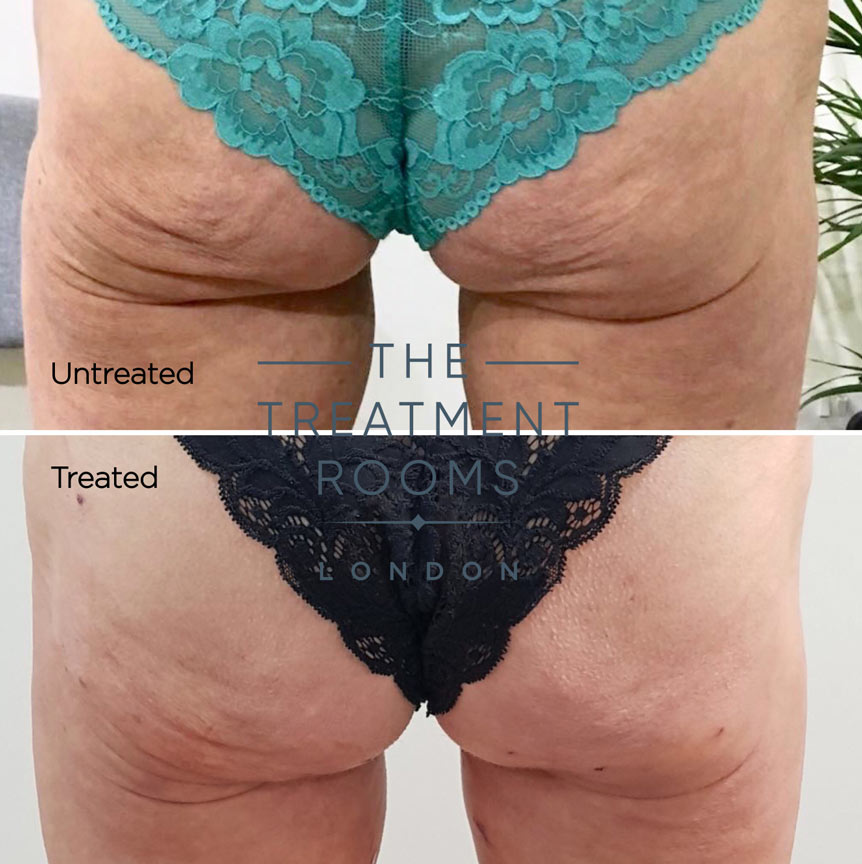 before and after buttock thread lift