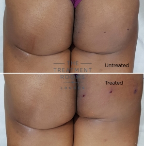 thread lift bum