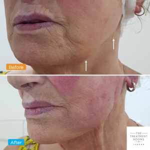 pdo thread lift clinic near me