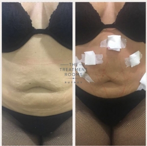 stomach thread lift london