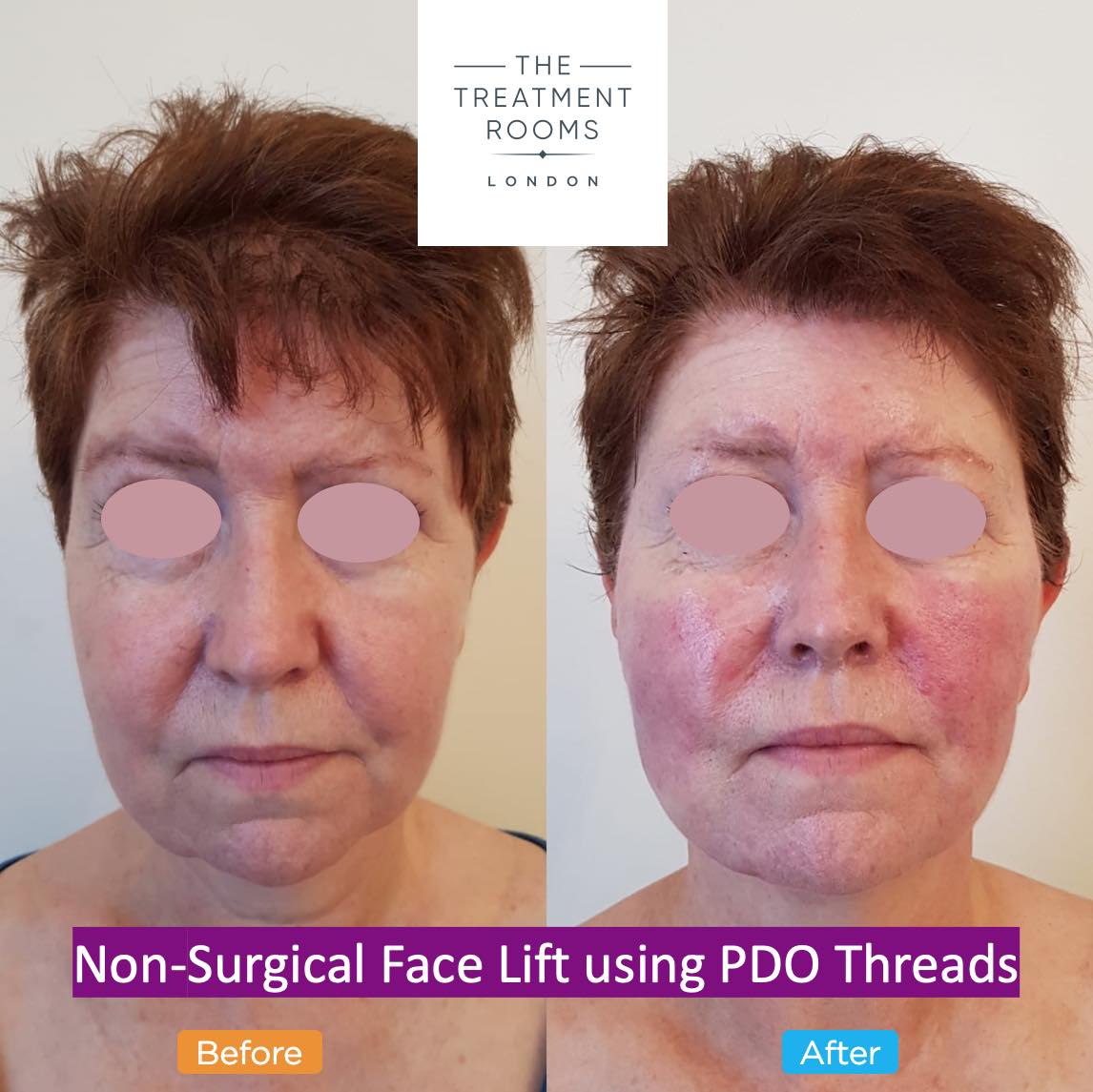 before and after non-surgical face lift with pdo threads