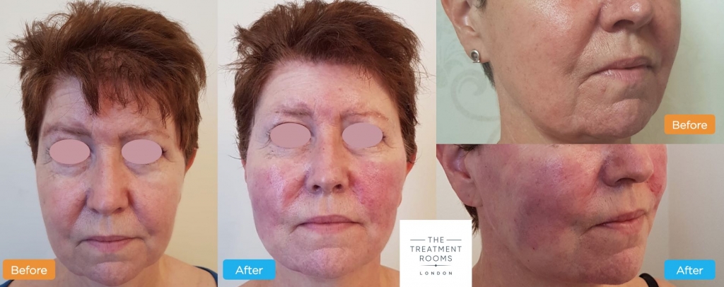 face thread lift london