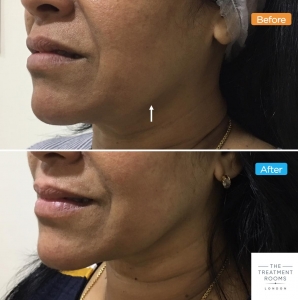 before and after jowl lift using pdo threads