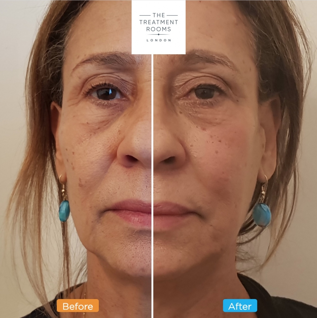 lady midcheek dermal filler before and after picture