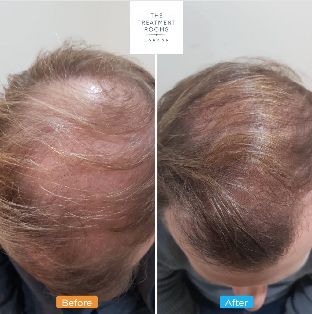 crown hair transplant before and after