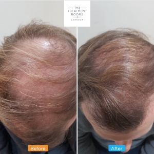 crown hair transplant before and after