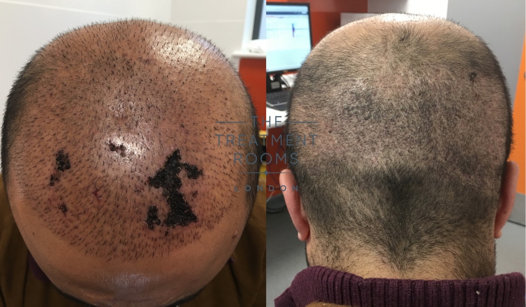skin necrosis after attending unregulated hair transplant clinic