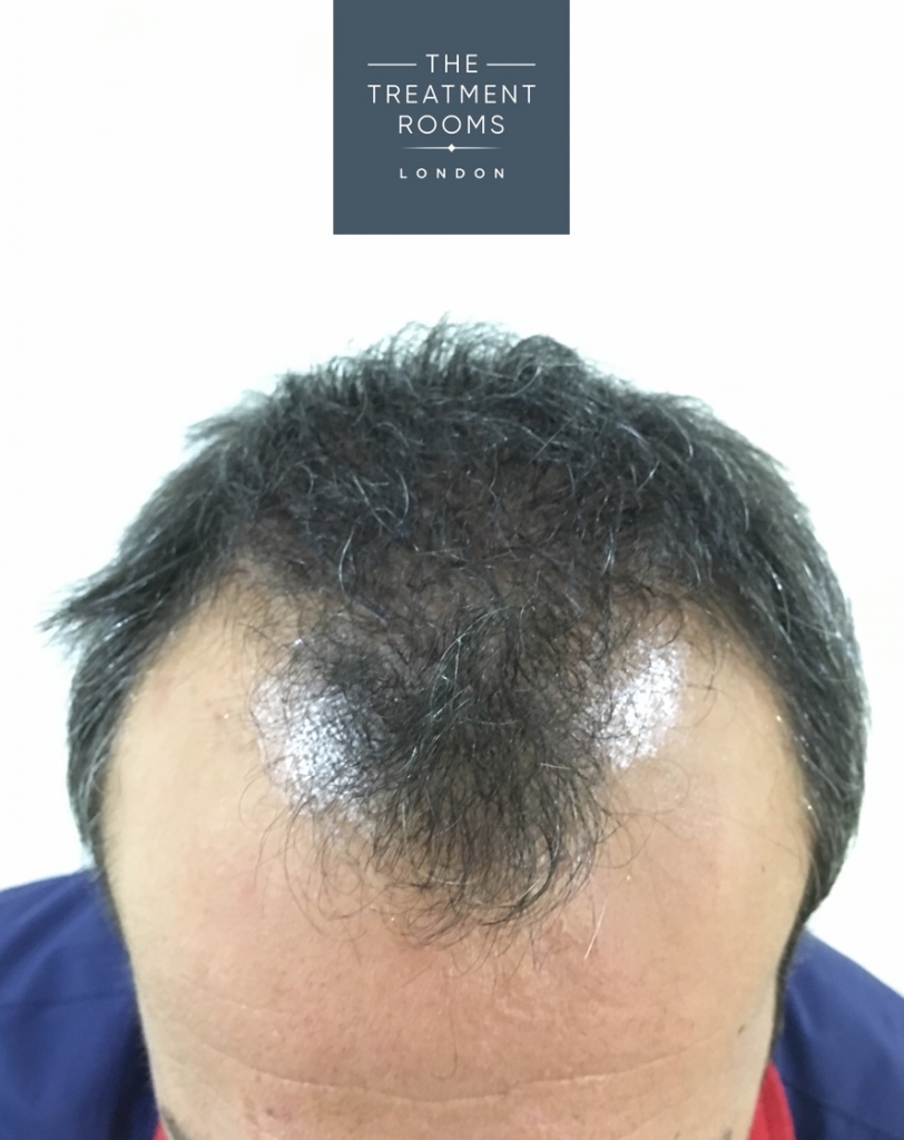 male hair loss recession