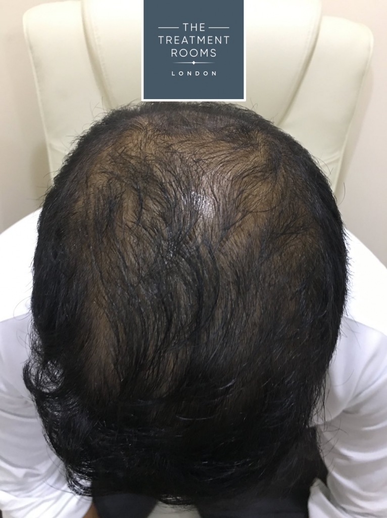 male hair loss generalised thinning