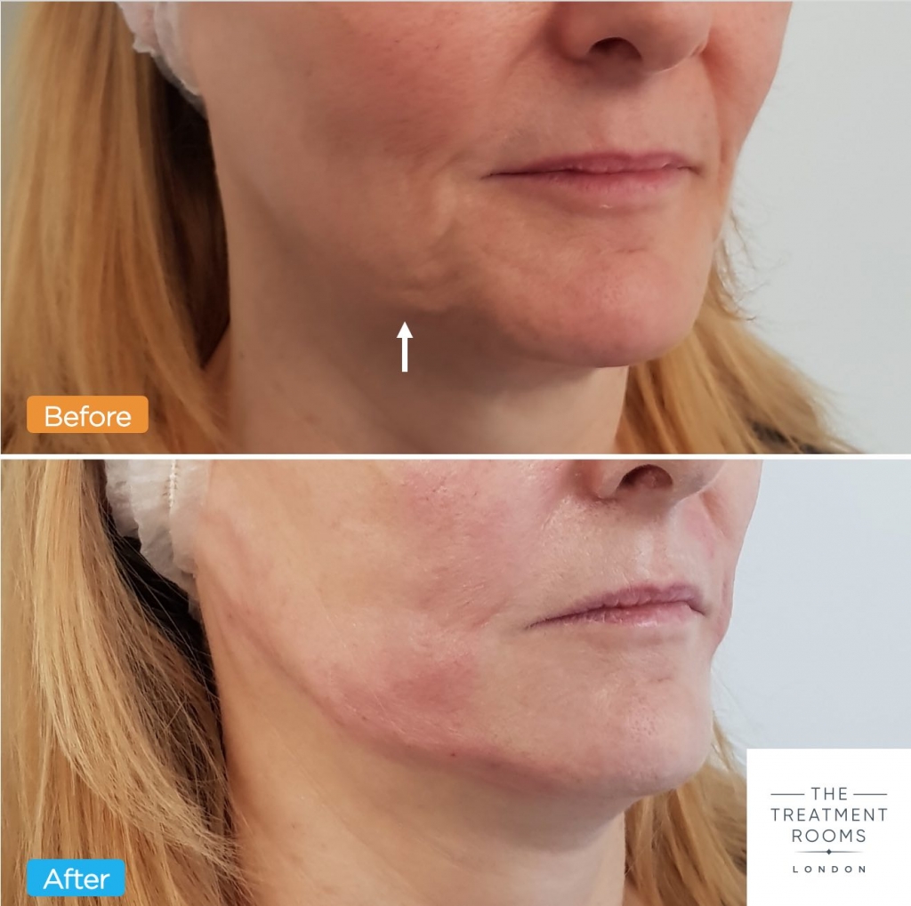 jowl thread lift