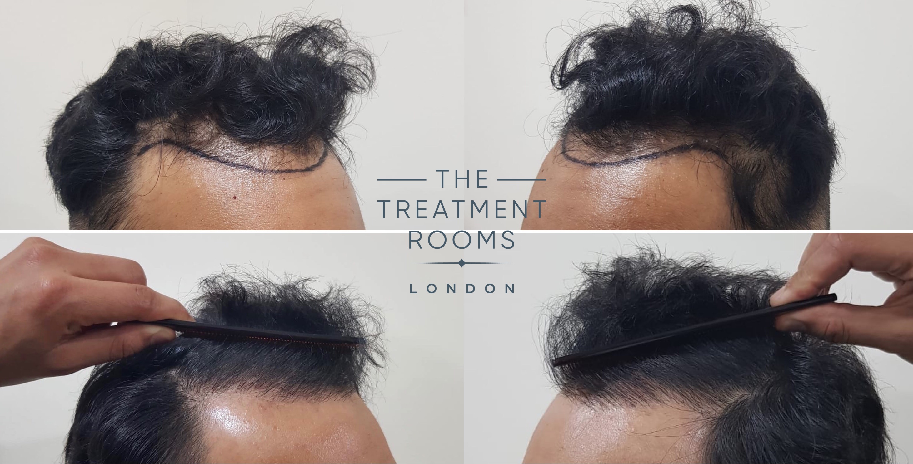 Front and temporal hairline hair transplant with comb