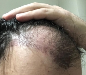 Redness after hair transplant