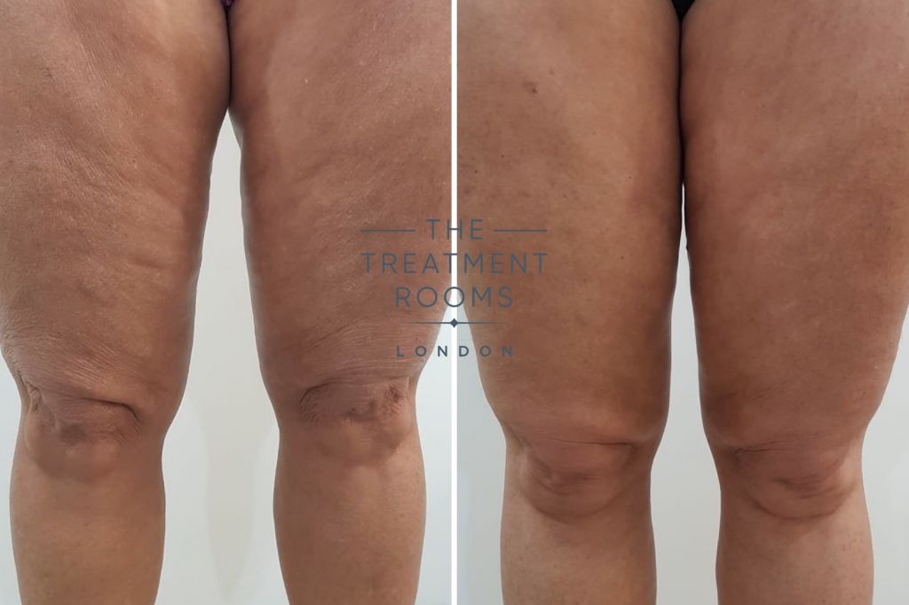 leg body thread lift